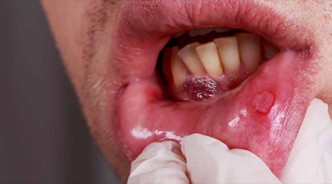 Phát hiện sớm ung thư khoang miệng thông qua các dấu hiệu bất thường