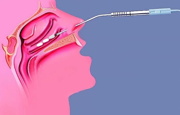 Đốt điện cuốn mũi dưới là phương pháp vô cùng hiệu quả trong việc thu nhỏ cuốn mũi dưới.