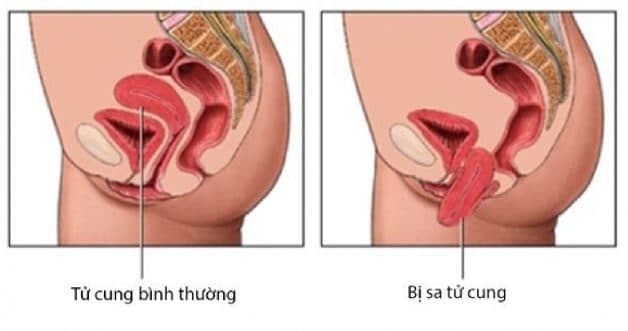 Phẫu thuật sa sinh dục là một phương pháp được áp dụng để xử lý triệt để việc sa sinh dục ở phụ nữ và đem lại cuộc sống bình thường trở lại