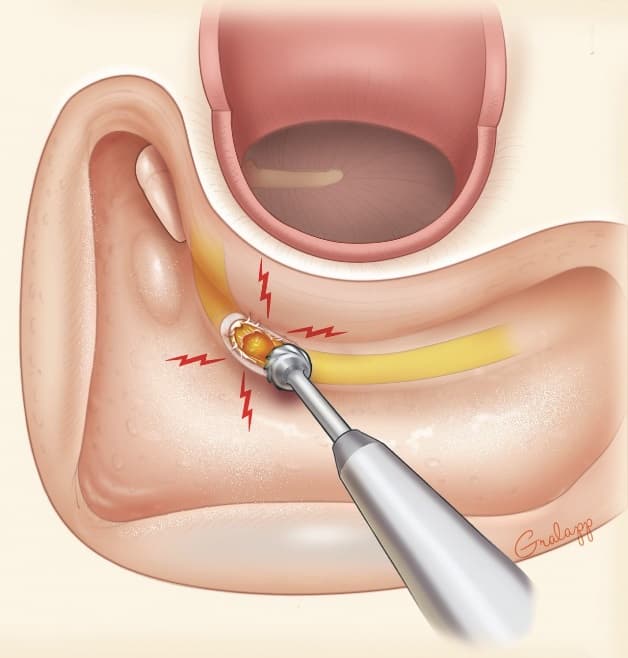 Phẫu thuật tiệt căn xương chũm