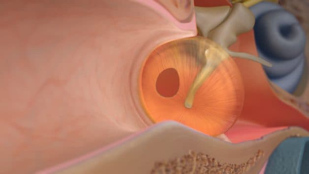 phẫu thuật vá nhĩ được thực hiện như thế nào