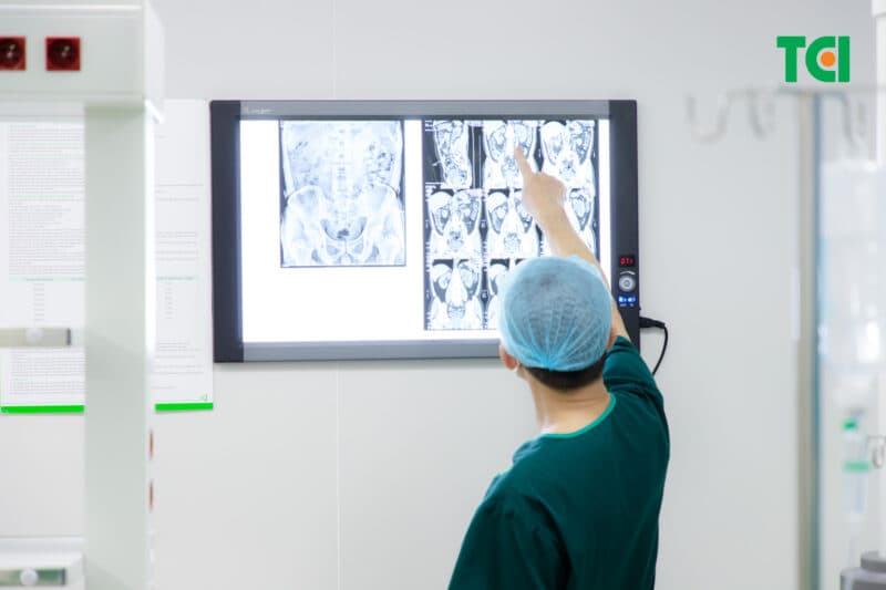 Cơ chế gây ứ nước thận độ 3 do sỏi thận, sỏi niệu quản