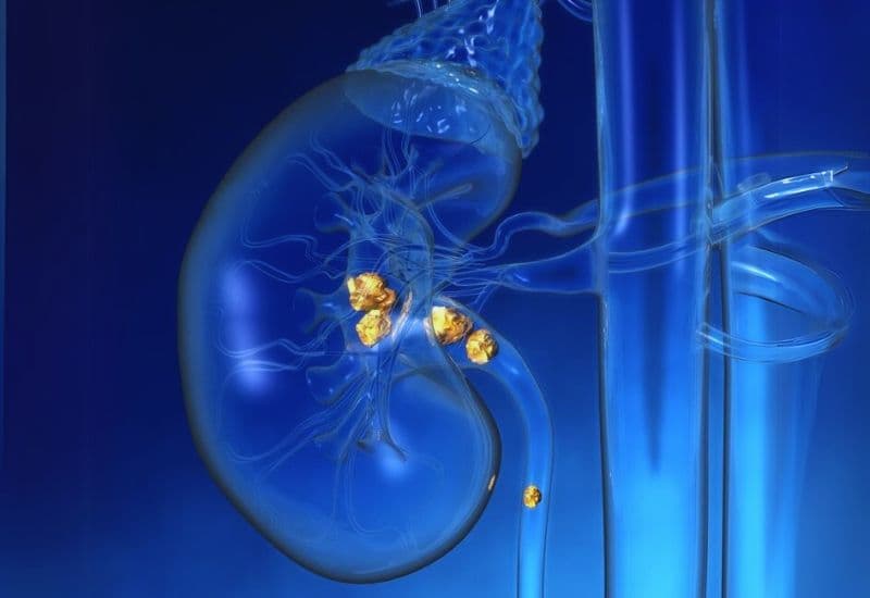 Tại sao sỏi thận, sỏi niệu quản có thể khiến đài bể thận bị giãn?