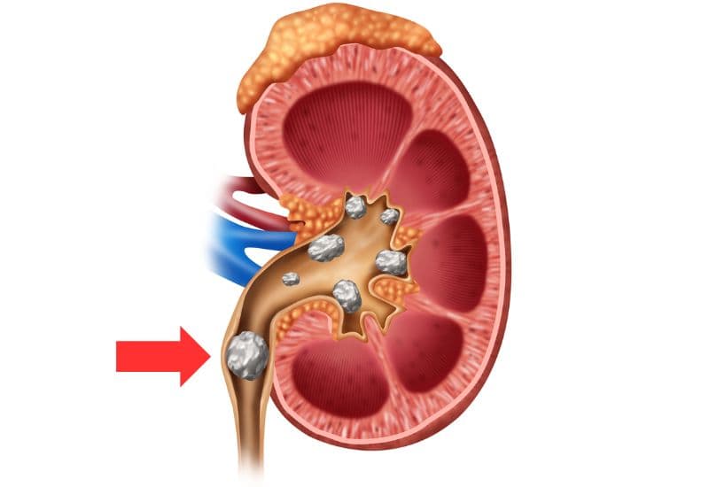 Sỏi niệu quản 1/3 trên và cơ chế gây giãn đài bể thận niệu quản