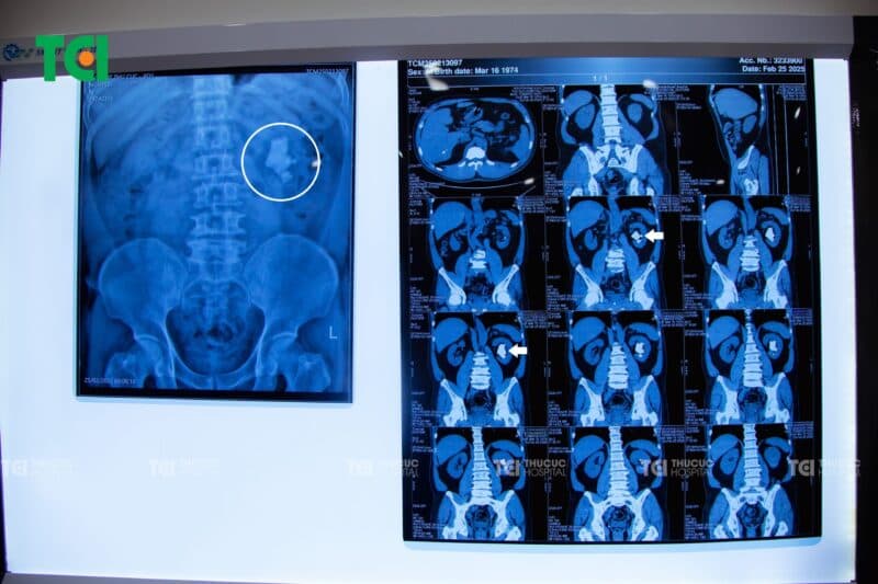 Phát hiện “tảng đá khổng lồ” trong thận sau cơn tai biến