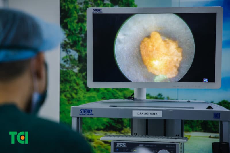 Tán sỏi công nghệ cao