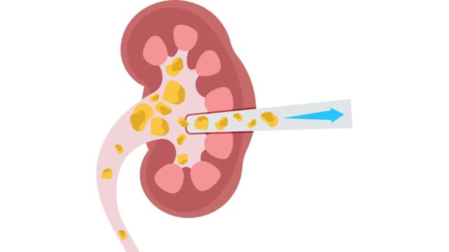 Cách điều trị thận bị ứ nước do sỏi tiết niệu