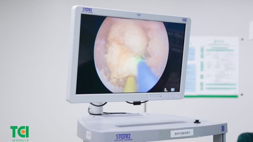 Tán sỏi bằng laser: Loại bỏ sỏi không mổ, không đau tại TCI