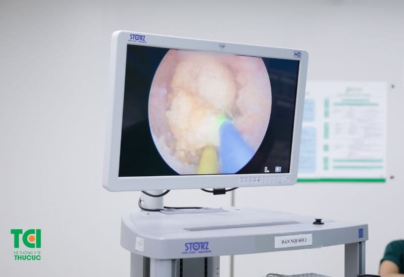 Giải pháp tối ưu: Tán sỏi thận tiết niệu bằng laser tại Thu Cúc TCI