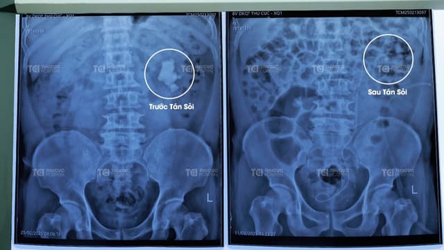 “Cân não” tán sỏi san hô khổng lồ bảo toàn sức khỏe cho bệnh nhân hậu tai biến