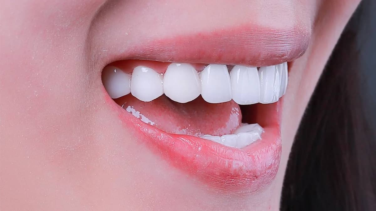 Tẩy trắng răng – Phương pháp và thời điểm thực hiện