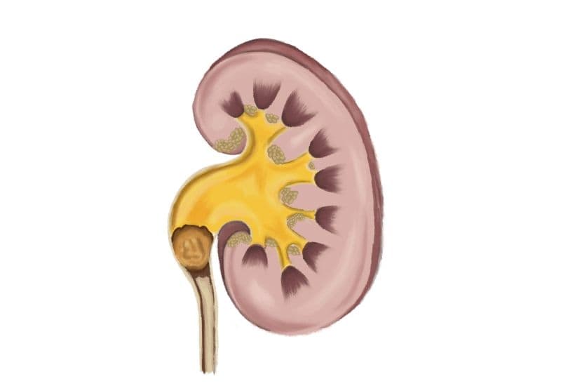 Cơ chế gây thận bị ứ nước do sỏi tiết niệu