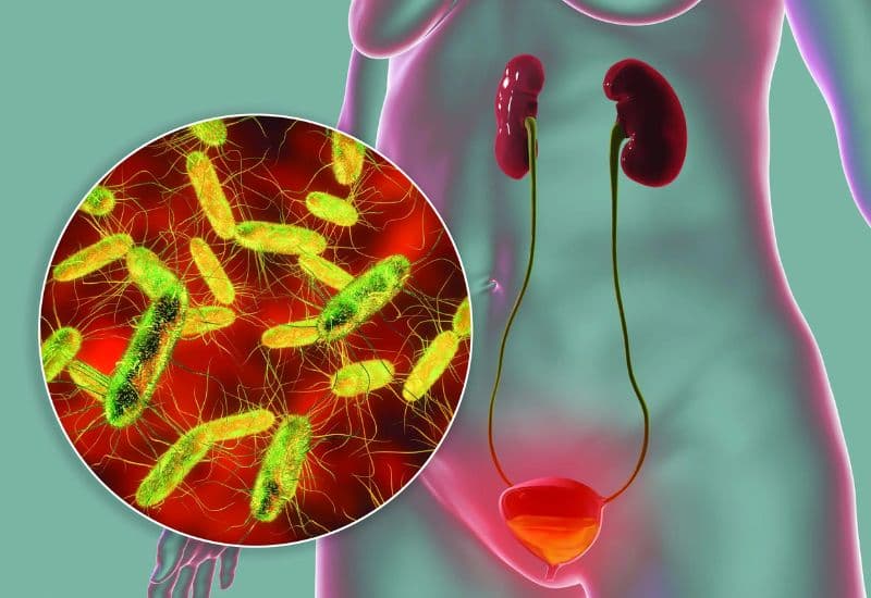 Thận ứ nước nhiễm khuẩn tác động như thế nào đến sức khỏe?