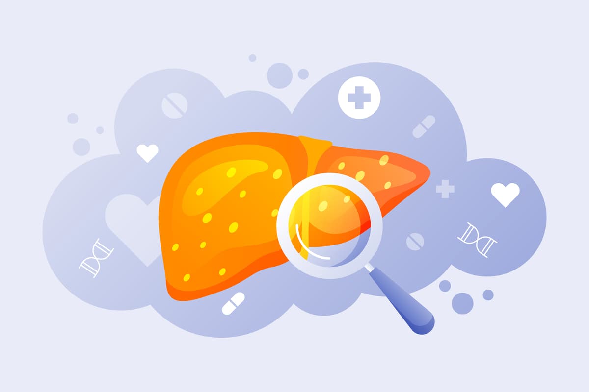 Gan nhiễm mỡ là tình trạng chất béo tích tụ quá nhiều, chiếm hơn 5-10% trọng lượng của gan.