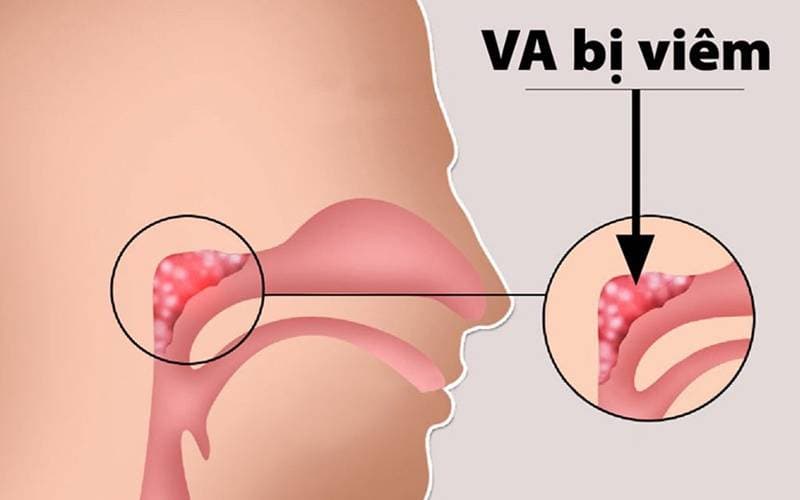Trẻ bị viêm VA là sao