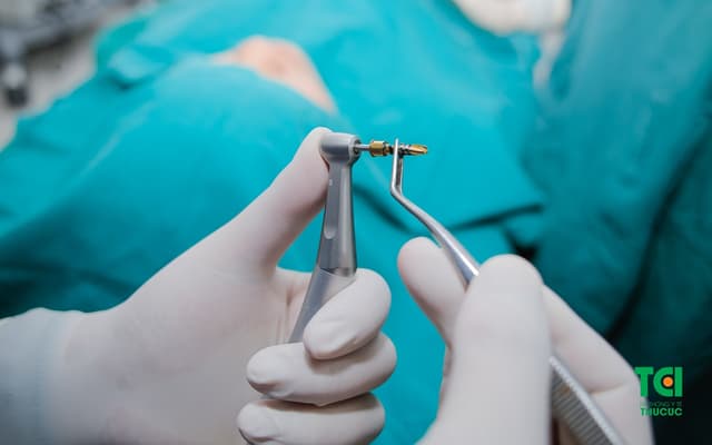Công nghệ trồng răng Implant hiện đại