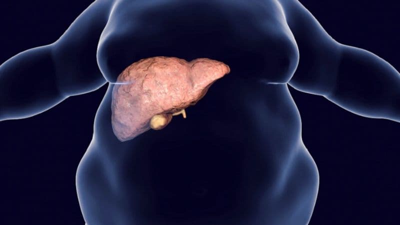 Viêm gan nhiễm mỡ không do rượu là tình trạng gì?