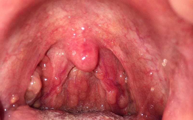 Viêm họng hạt mạn tính nguy hiểm không