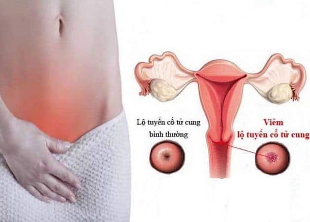 Nếu không được phát hiện và điều trị kịp thời, lộ tuyến tử cung có nguy cơ biến chứng thành nhiều bệnh nguy hiểm