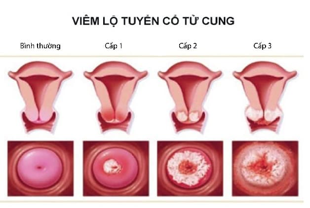 Viêm lộ tuyến cổ tử cung là căn bệnh nhiều chị em gặp phải
