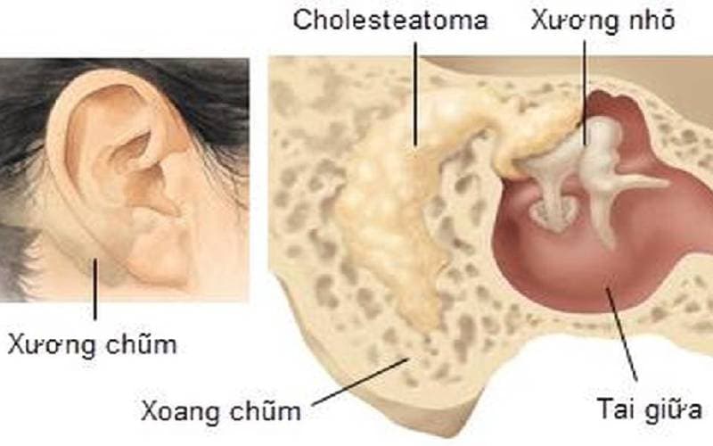 viêm tai xương chũm có cholesteatoma nguy hiểm không
