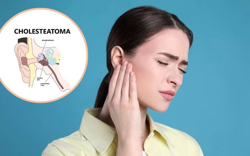 viêm tai xương chũm có cholesteatoma vì đâu