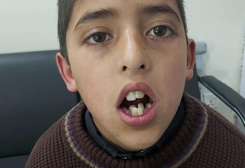 Một trong những ảnh hưởng đáng lo ngại của viêm VA mạn tính là sự thay đổi cấu trúc khuôn mặt, đặc biệt khi trẻ bị viêm VA mạn tính trong giai đoạn phát triển.