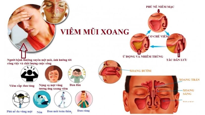 Viêm xoang mũi và những điều cần biết về bệnh