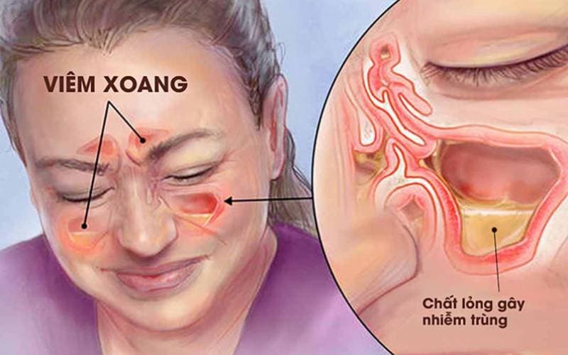 viêm xoang mũi là bệnh gì