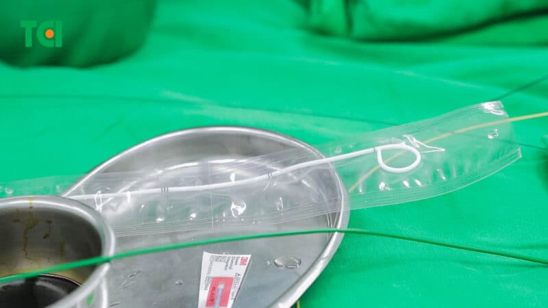 Rút ống jj tiểu ra máu có nguy hiểm không?