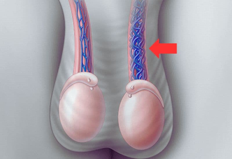 Giãn tĩnh mạch thừng tinh là gì và cơ chế sinh bệnh