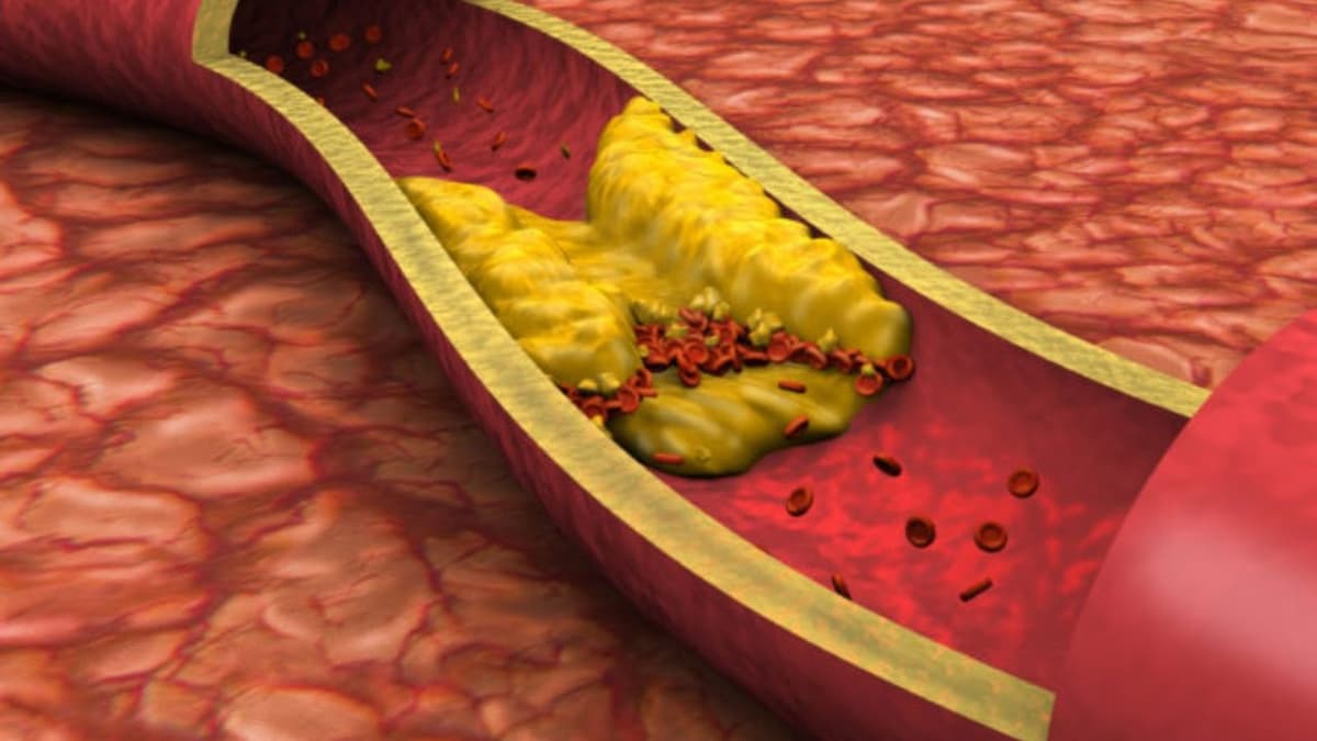 Bệnh máu nhiễm mỡ: Nguyên nhân, triệu chứng và cách điều trị