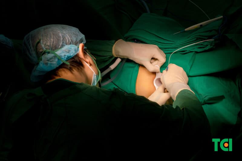 Đốt trĩ Laser Diode: Dùng năng lượng laser tác động vào búi trĩ, làm xẹp mô trĩ mà không cần cắt bỏ