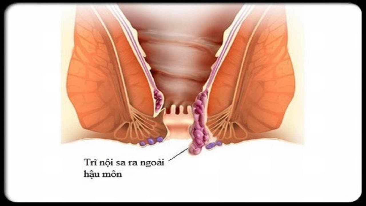bệnh trĩ là do đâu