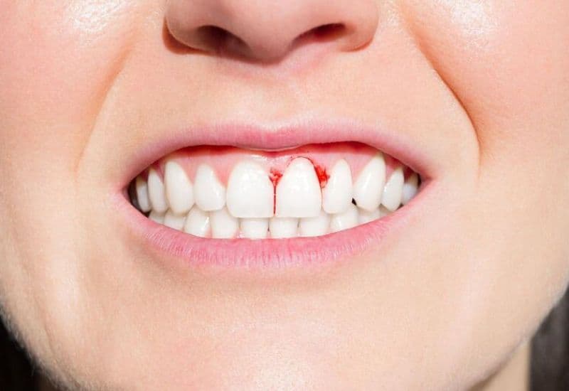 Viêm lợi khi mang thai có thể tác động tiêu cực đến sức khỏe của mẹ bầu trong suốt thai kỳ.