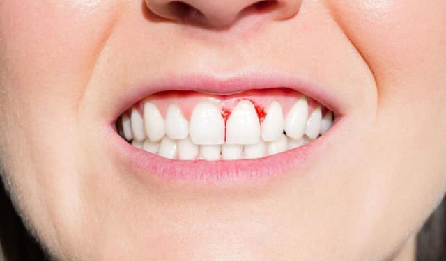 Bị viêm lợi khi mang thai: Nguy cơ và ảnh hưởng đến thai nhi?