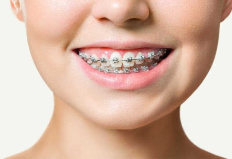 Chăm sóc răng miệng đúng cách sau niềng giúp bảo vệ răng và nướu.