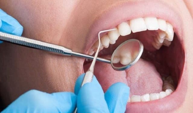 Tần suất lấy cao răng hợp lý để bảo vệ nướu và răng