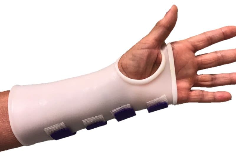 Cách sơ cứu đúng khi bị gãy xương quay cẳng tay