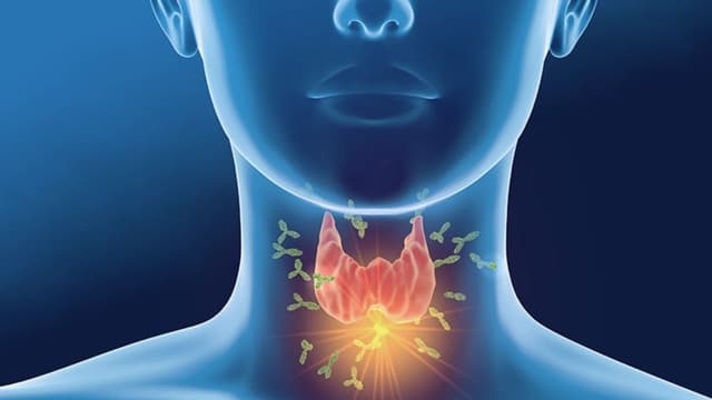 &#8220;Soi&#8221; dấu hiệu viêm tuyến giáp để nhận diện bệnh sớm