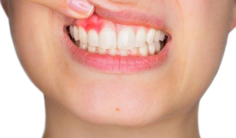 Đau lợi: Nguyên nhân, dấu hiệu nhận biết và cách điều trị hiệu quả