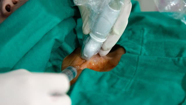 Điều trị u tuyến giáp lành tính không mổ không nằm viện