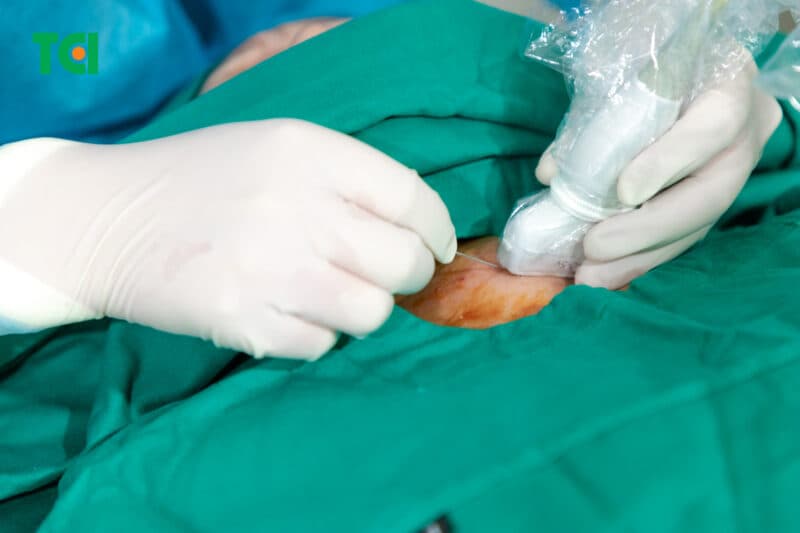 Điều trị u tuyến giáp lành tính không mổ: Tiến bộ từ công nghệ RFA