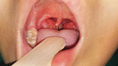 Điều trị viêm amidan cấp an toàn, hiệu quả