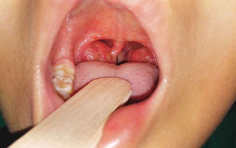 Điều trị viêm amidan cấp bằng cách nào