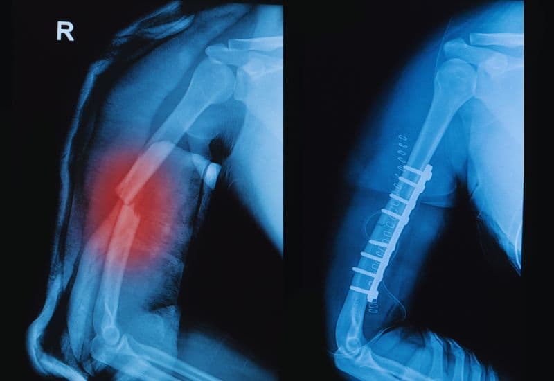 Cách điều trị gãy xương cánh tay hiệu quả