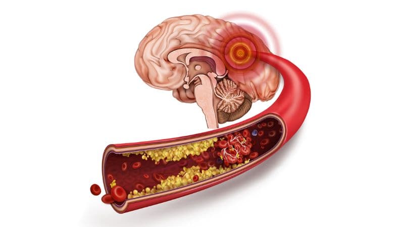 Nguy cơ đột quỵ do xơ vữa mạch máu