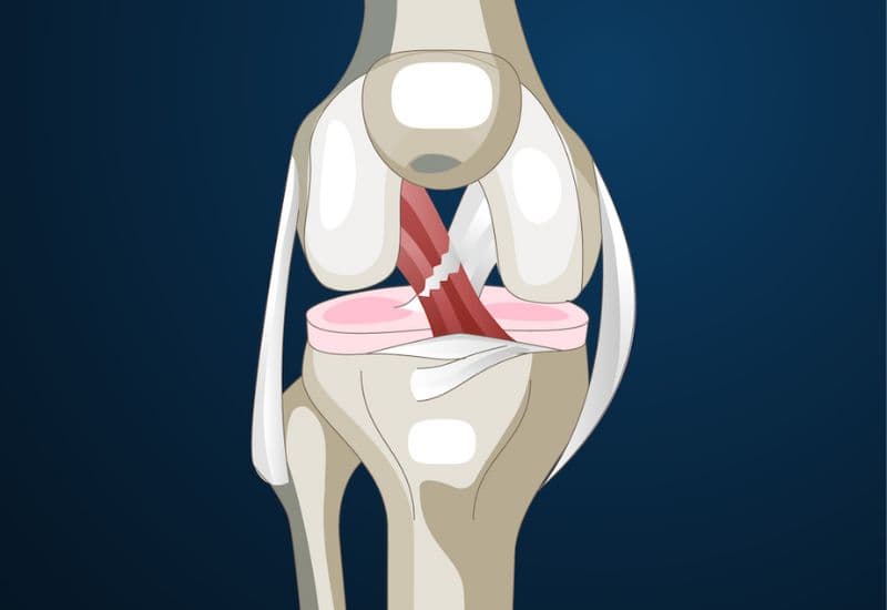 Đứt dây chằng chéo trước của khớp gối là gì?
