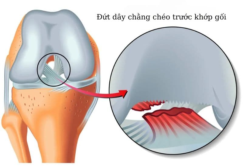 Chấn thương dây chằng chéo trước khớp gối