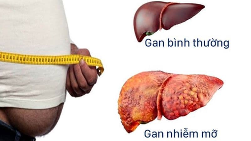 Gan nhiễm mỡ ở người cao tuổi